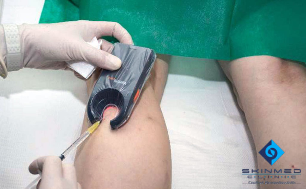 Procedurile de revizuire a varicelor - Scleroterapie cu revizuiri venelor varicoase